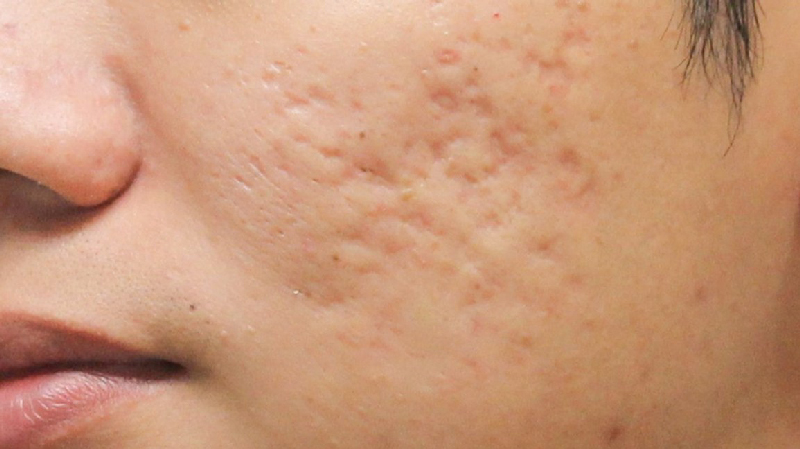 how to get rid of irritating acne scars