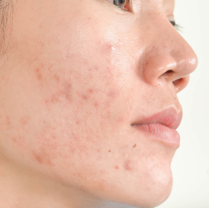 how to get rid of acne