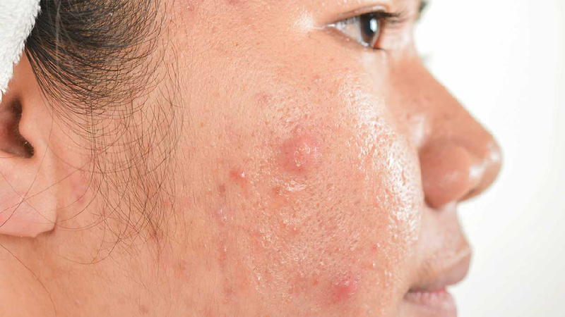 treatments to get rid of acne