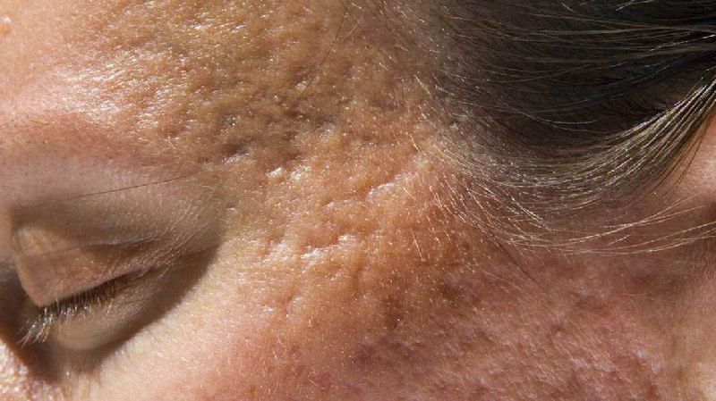 rolling is a type of acne scars