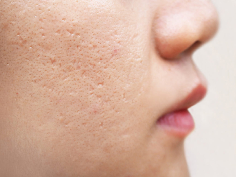 treatment for acne scars
