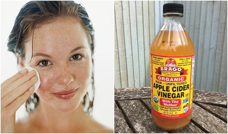 apple cider for pimples