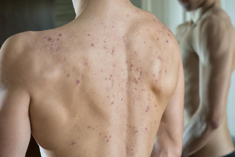 causes of back acne