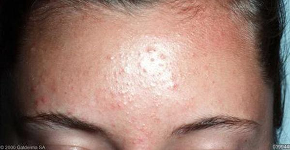 how to treat fungal acne on face