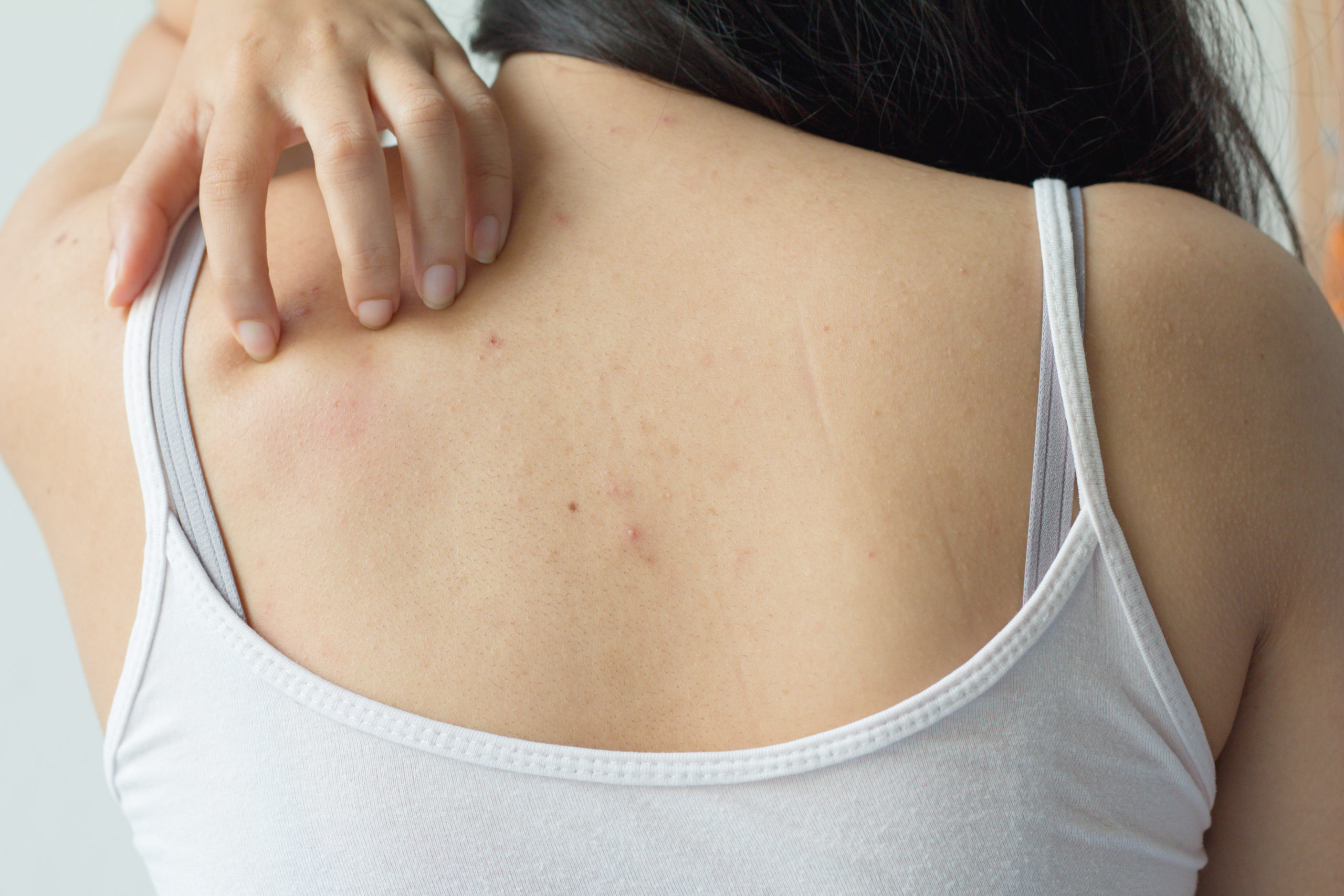 how to get rid of back acne effectively