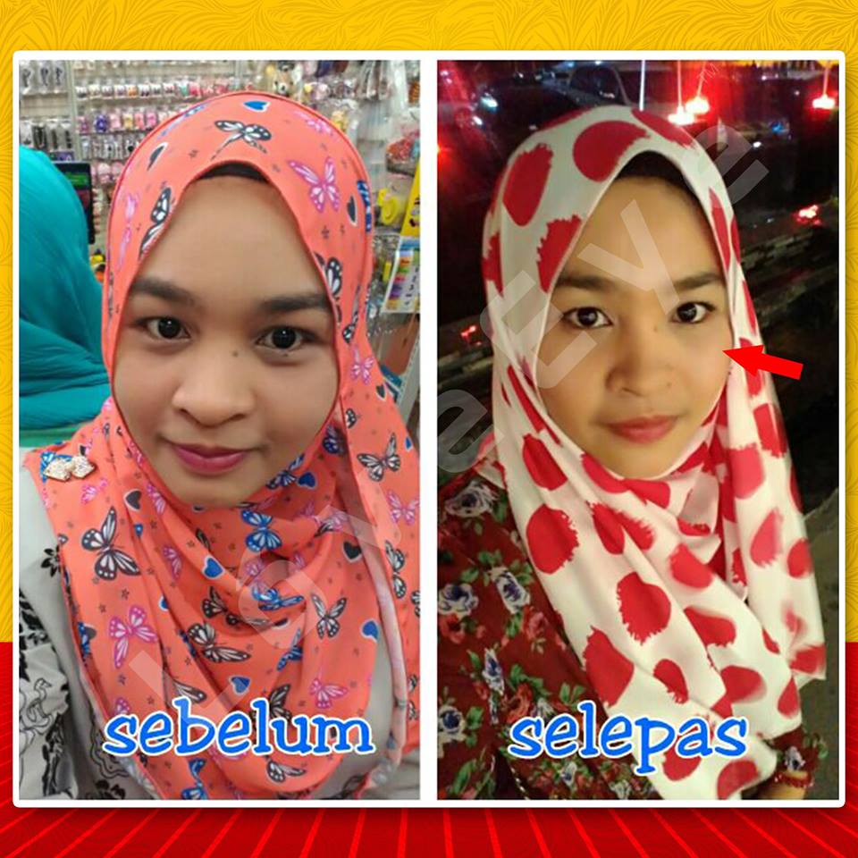 hilangkan eyebag di asrama amat senang