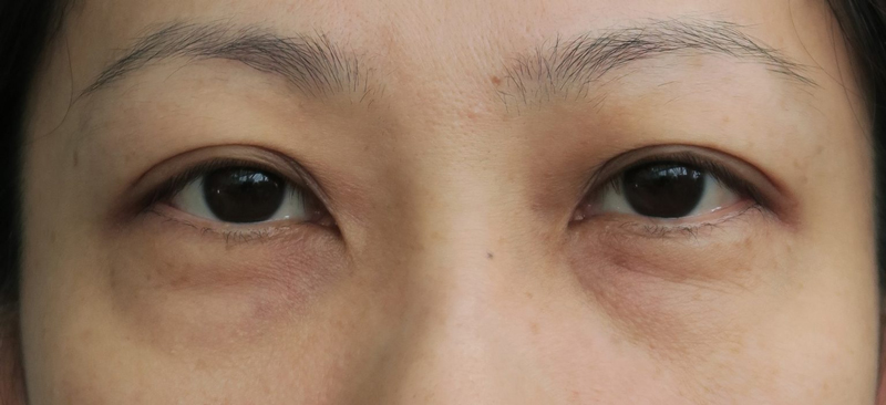 vitamin untuk hilangkan eyebag