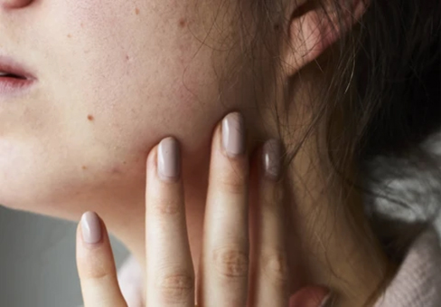 serum terbaik untuk jerawat