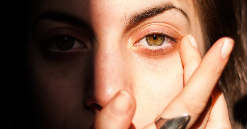 sun overexposure cause dark circles
