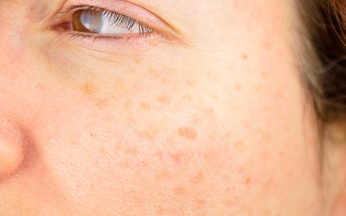 sunspots on face