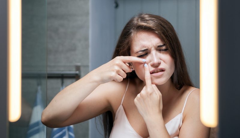 skin discoloration on face because squeezing pimples